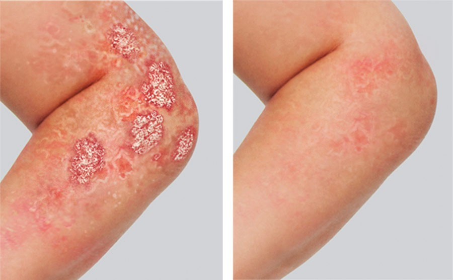 Effective Treatments of Psoriasis